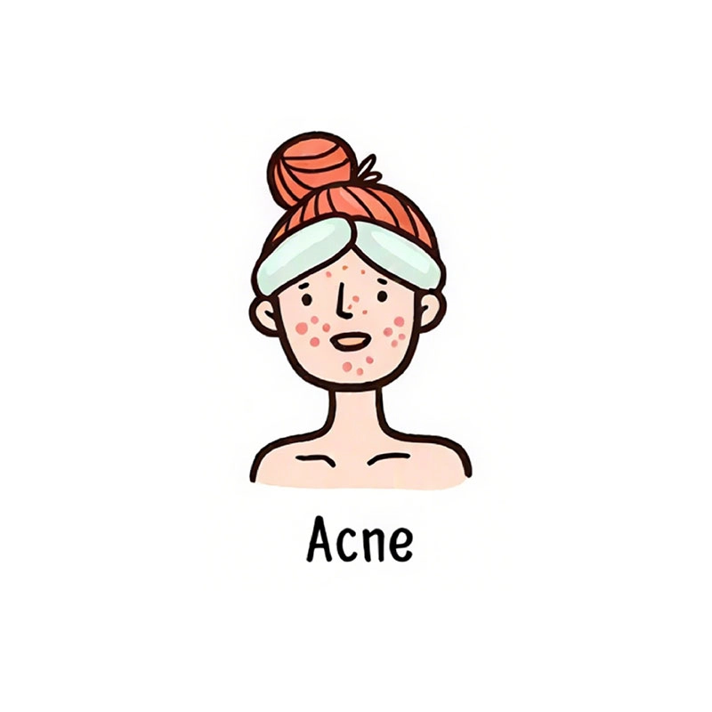 acne-prone-skin - RYSUN